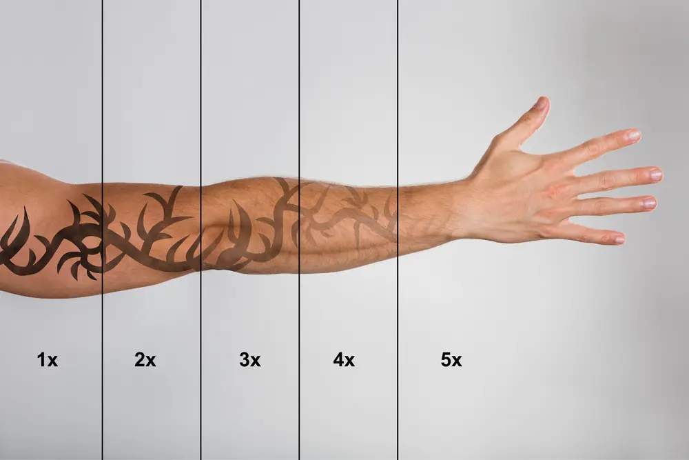 banner remocao tatuagens
