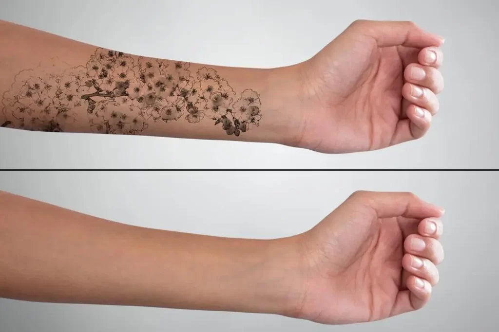 remover tatuagem matosinhos
