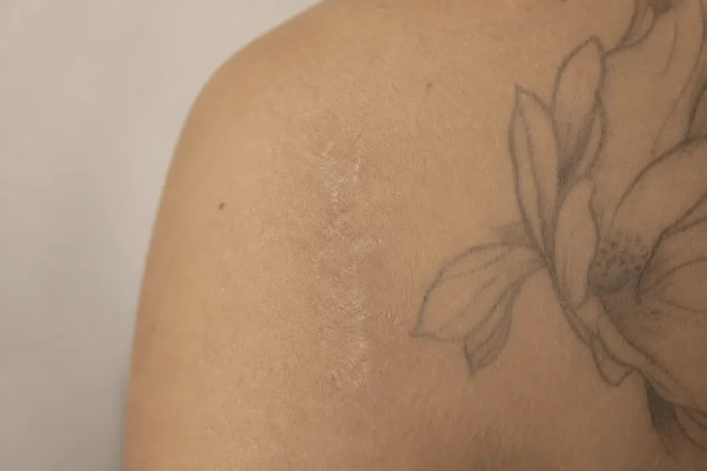 Remoção de Tatuagem a Laser Deixa Cicatriz?