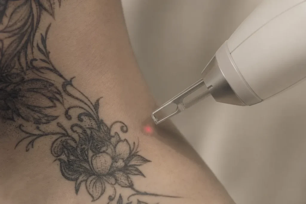 Remoção de Tatuagem no Rosto: É Seguro?