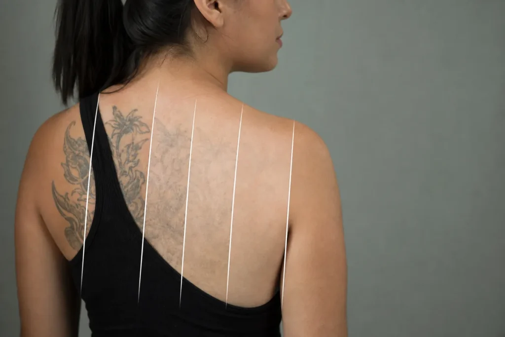 Remoção de Tatuagem Grande Antes e Depois | Sessão a Sessão